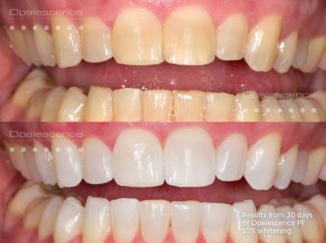„Opalescence” balinamoji dantų pasta (133g)-3